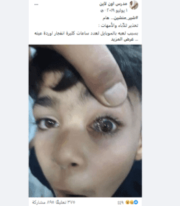 ادعاء انفجار أوردة العين 
